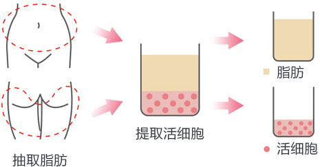 自体脂肪移植吸脂部位