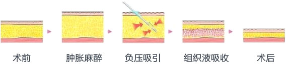 吸脂瘦脸5