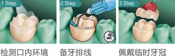 美牙冠12