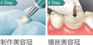 美牙冠13