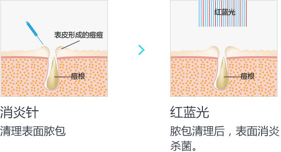 祛痘17