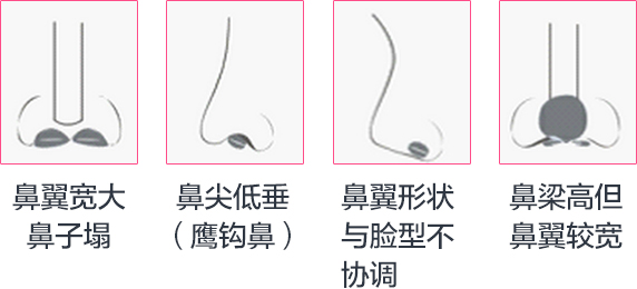 鼻翼缩小1