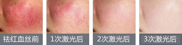 红血丝修复9