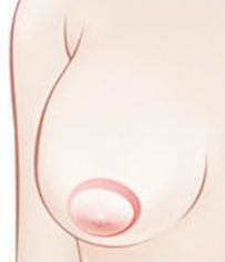 乳晕切开法矫正乳房下垂