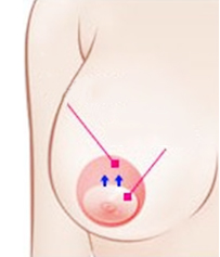乳晕切开法矫正乳房下垂