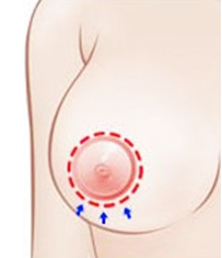 乳晕切开法矫正乳房下垂
