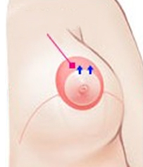 垂直切开法矫正乳房下垂