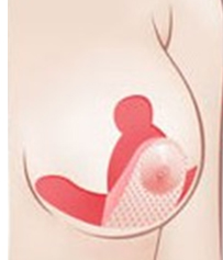O型切开法矫正乳房下垂
