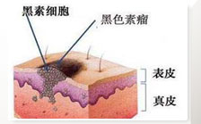 长痣的危害皮肤病变