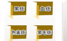 痣的分类