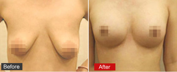 乳房下垂矫正效果