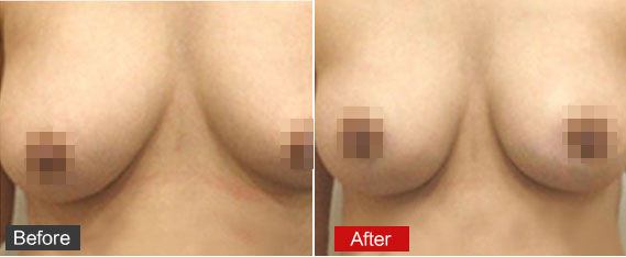 乳房下垂矫正对比图