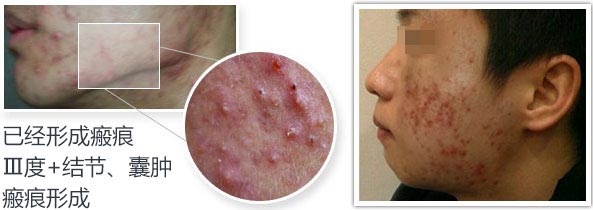祛痘16