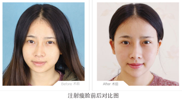 注射瘦脸前后对比图